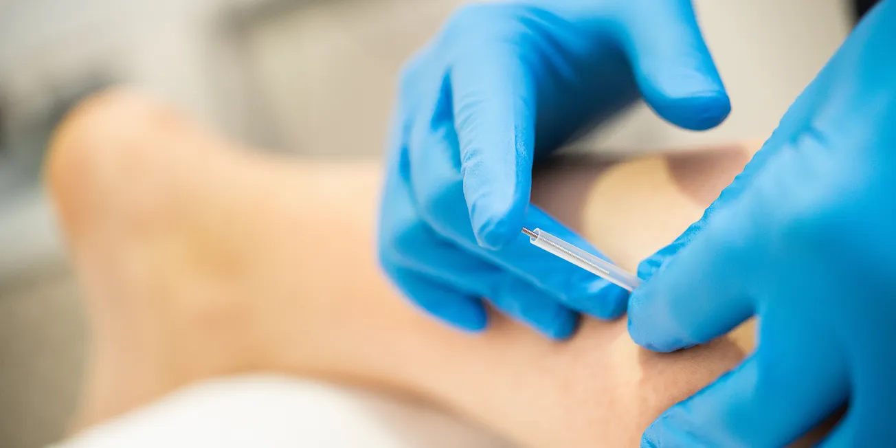 Behandling med nåler.